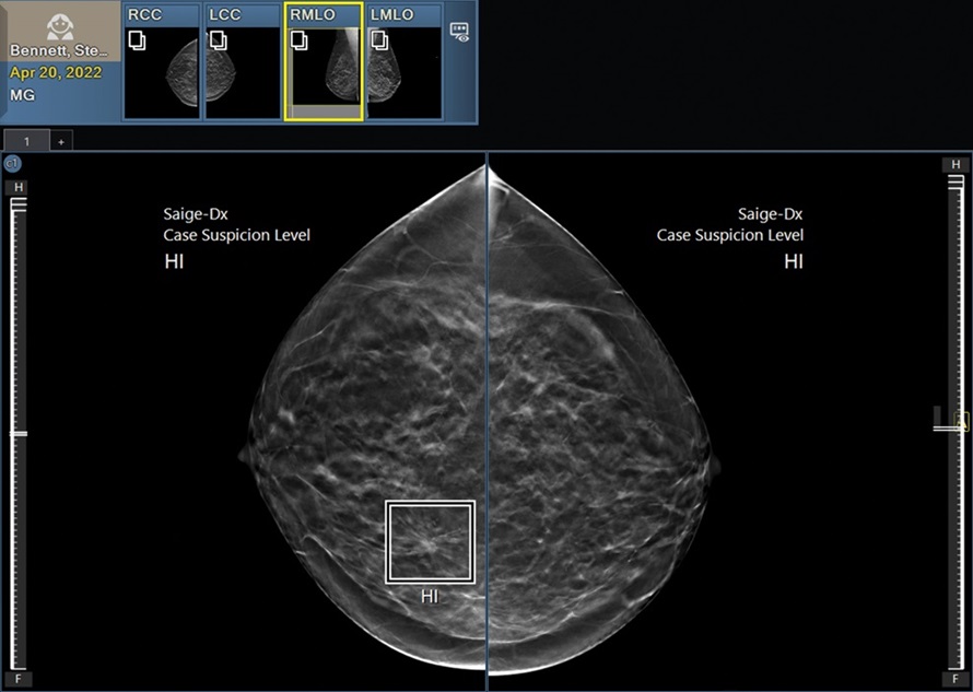 Imagen: Saige-DX es un sistema de IA categórico personalizado diseñado para ayudar en la detección del cáncer de mama (Fotografía cortesía de DeepHealth)